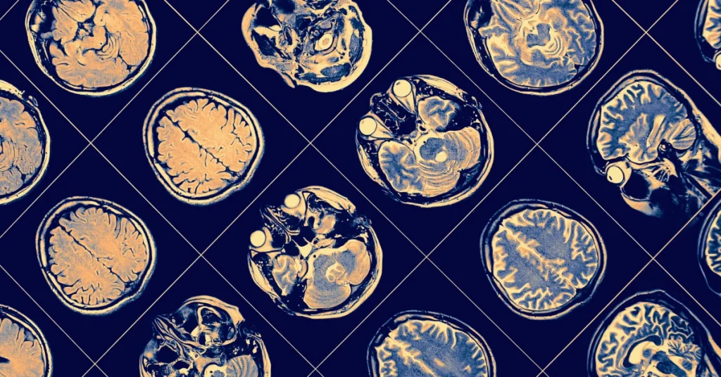 Multiple MRI brain scans used in neuropsychological testing to assess cognitive function and neurological conditions.